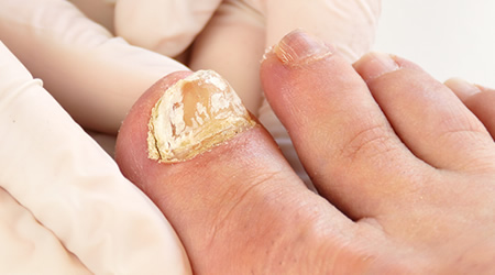 Fungal toenails